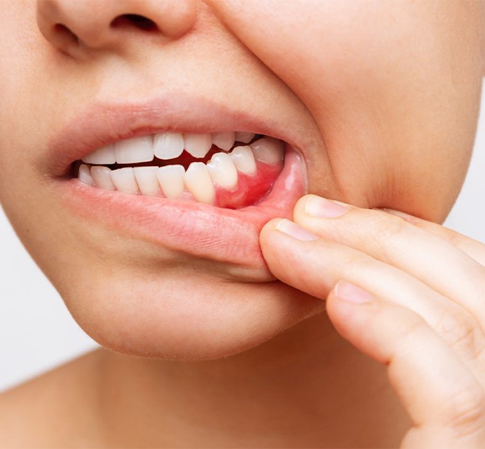 a person pulling down their lip to reveal swollen gums